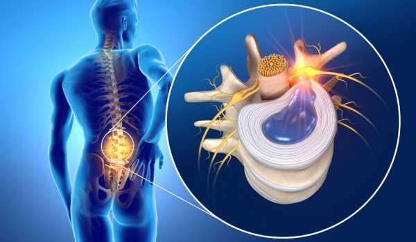 روش‌های پیشگیری از دیسک کمر دیسک خفیف و شدید + درمان و علائم