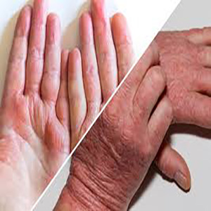 اگزما و پسوریازیس پوست: علل، علائم و روش‌های درمان